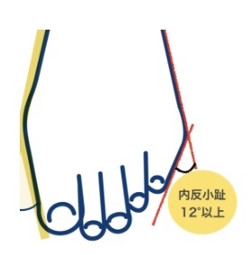 内反小趾の曲がっている角度の説明