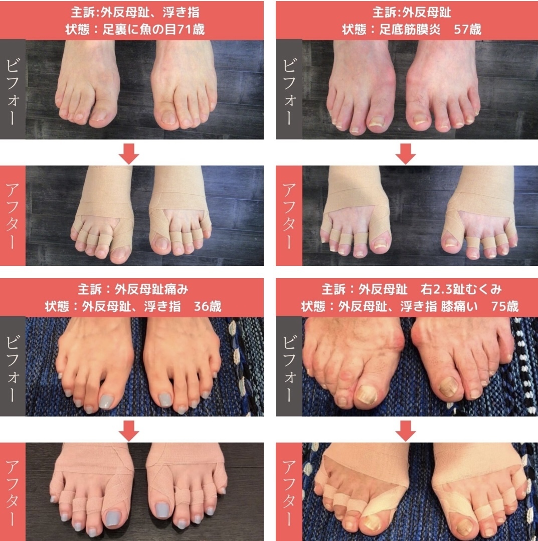 外反母趾の足を整足テーピングで巻いた写真