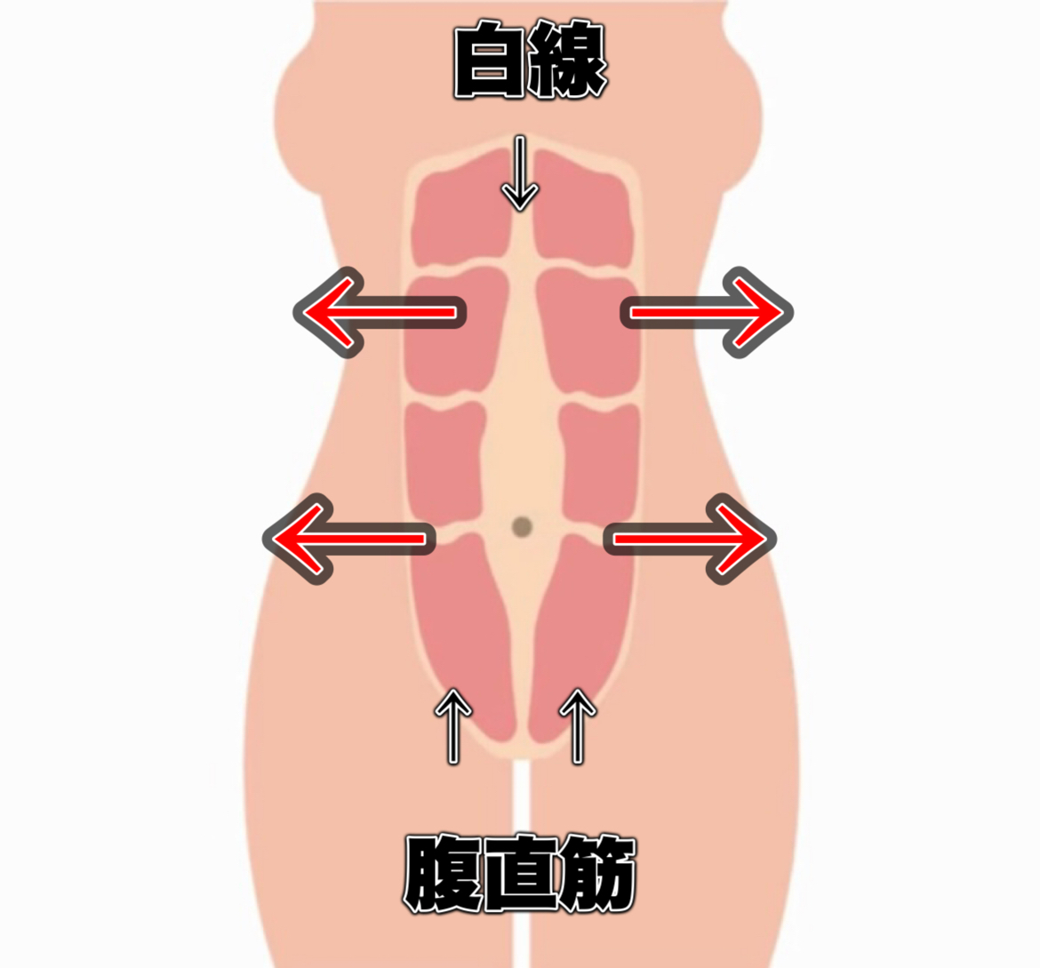 腹直筋の離開