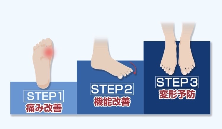 内反小趾の改善へのステップ説明