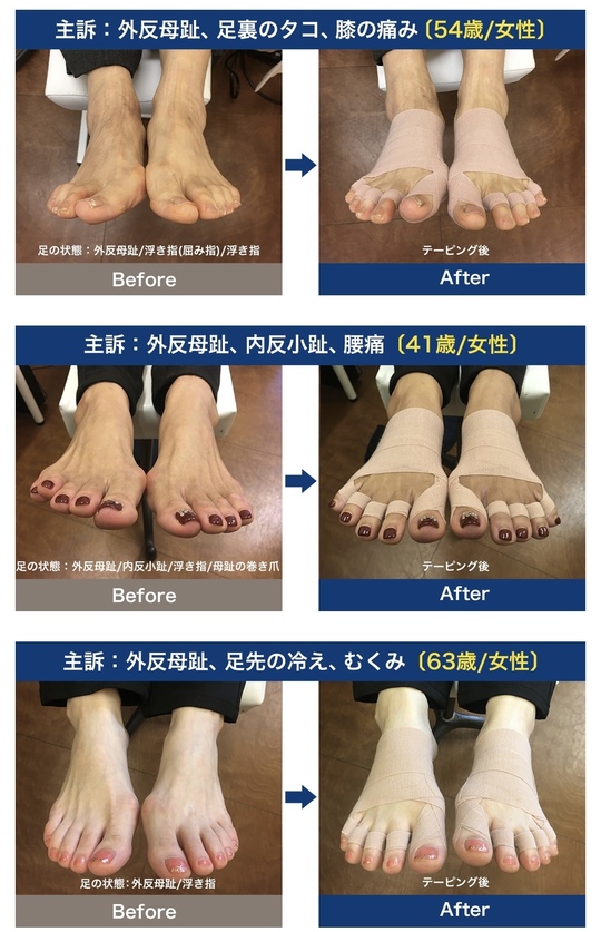 外反母趾の足を整足テーピングで巻いた写真