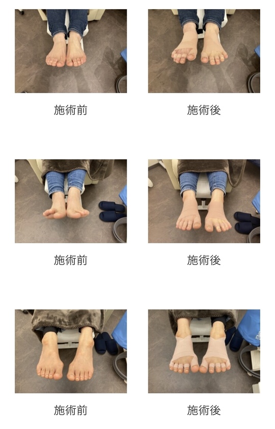 整足テーピングの施術例