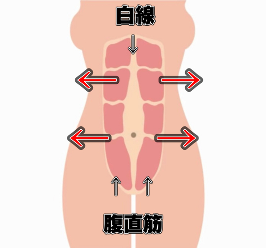 腹直筋の離開